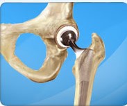 Minimally Invasive Total Hip Replacement - Farbod Malek, MD